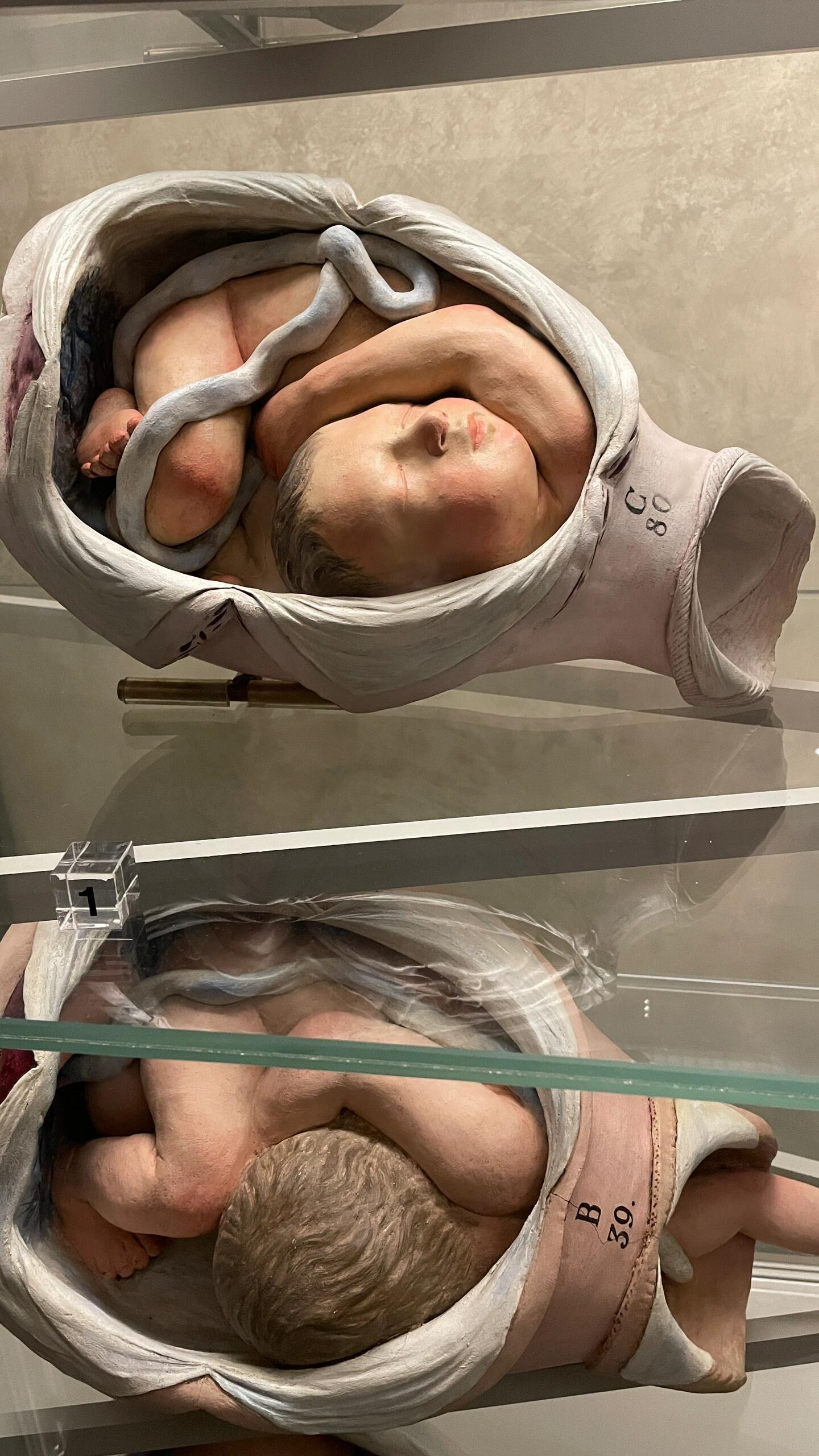 胎位不正 好吓人啊 