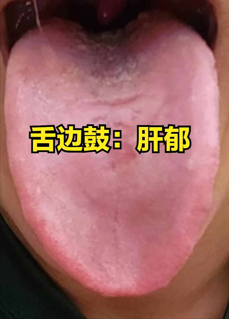舌边暗藏肝病信号！舌边鼓--肝郁，舌边红--肝火，舌边白--肝血虚，舌边紫--气