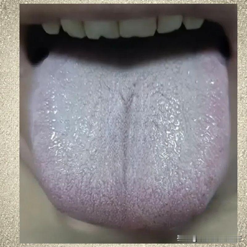 寒、淤、虚全集中在一个舌象上，华佗在世也难调理，只有这两招可解！

患者问题：浑