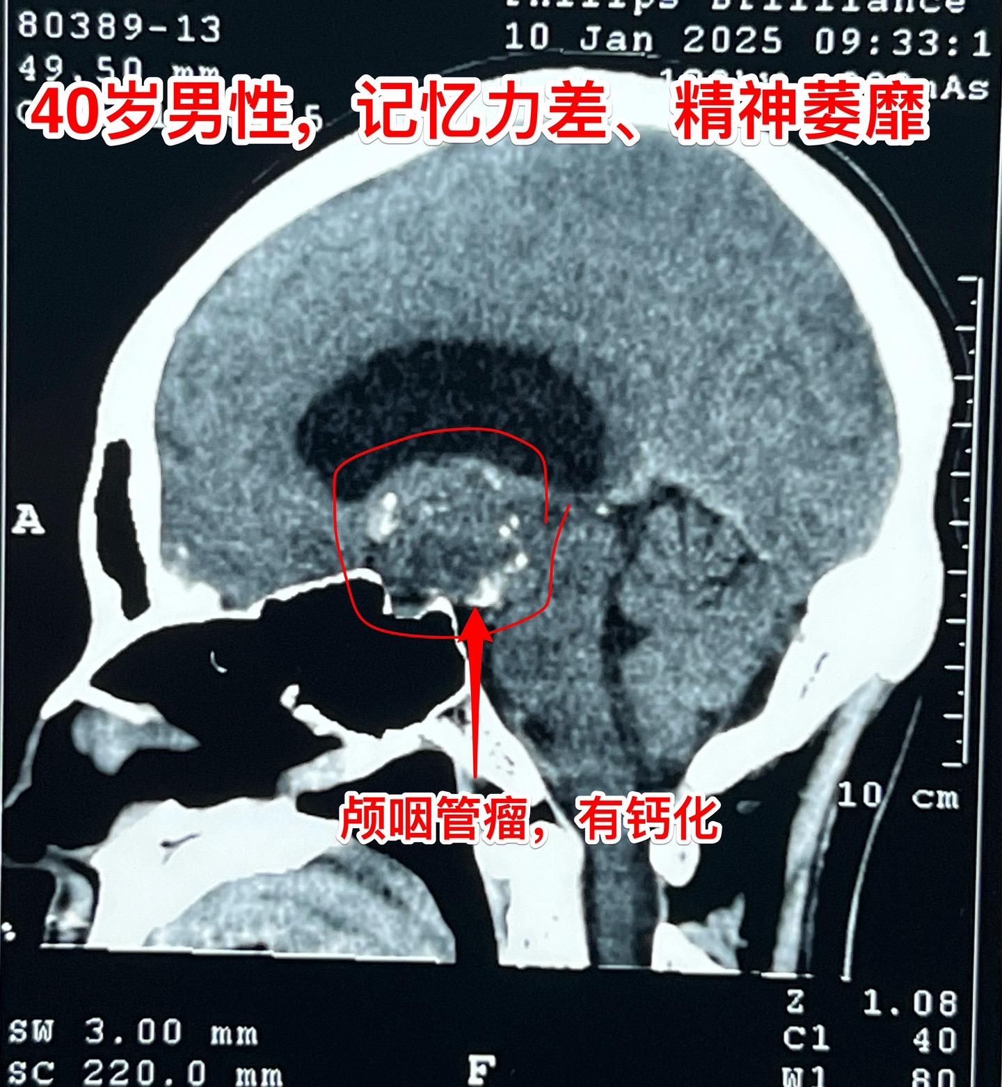 40岁男性记忆力差、精神萎靡、不能行走。患者山西省大同人，家人中有两个...