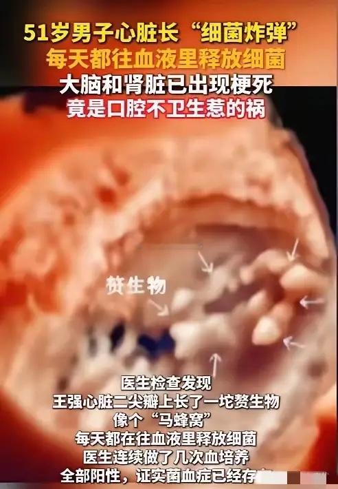太吓人了！广东深圳一位51岁的男子，常年不刷牙，牙龈出血、红肿全不当回事。最后到