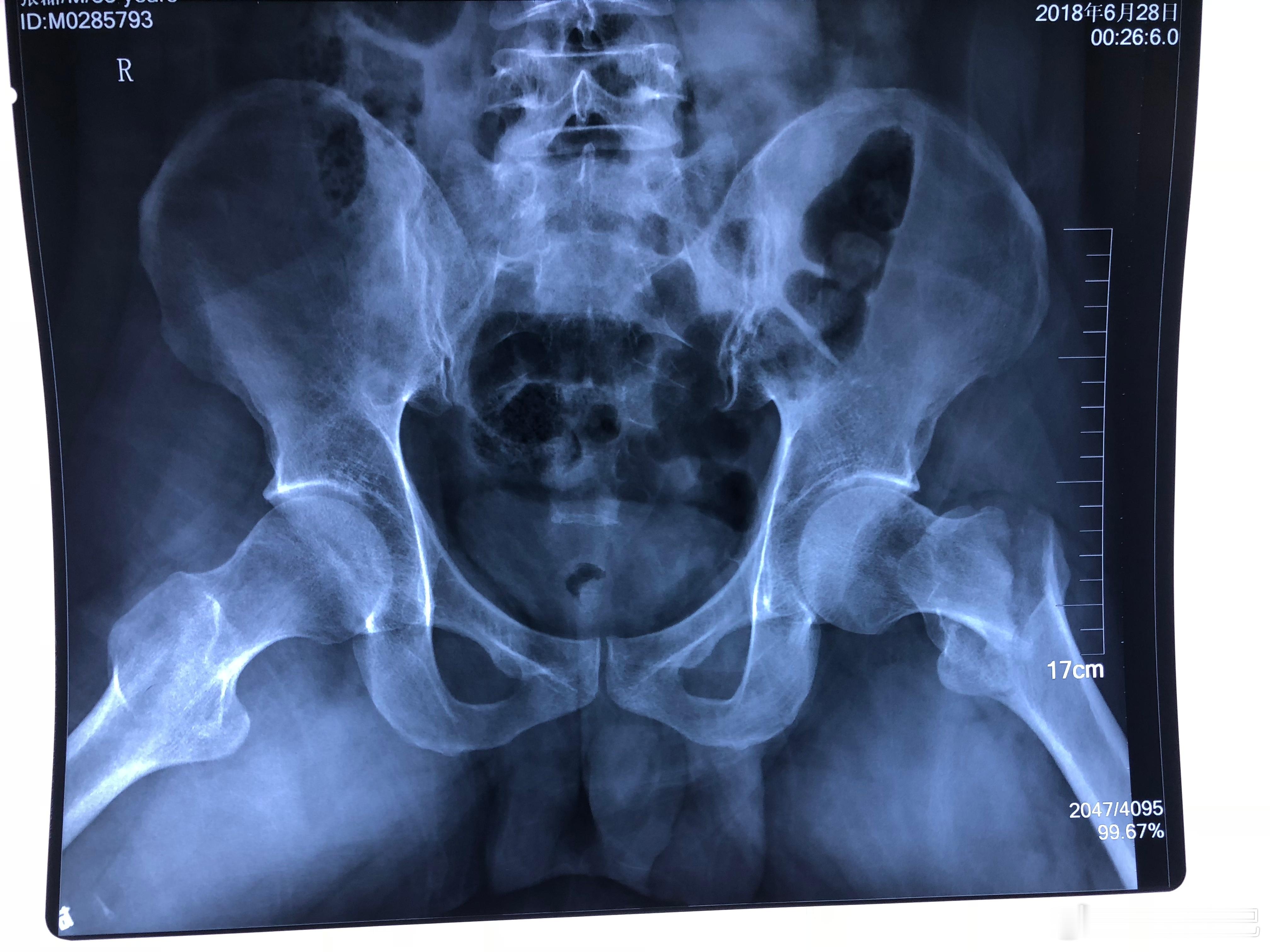小朋友问我当年骨折的时候什么感觉？说实话，大腿骨折真的痛彻心扉，已经超过我忍耐极