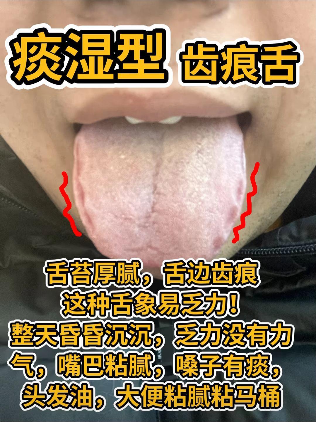3种齿痕舌有什么区别？