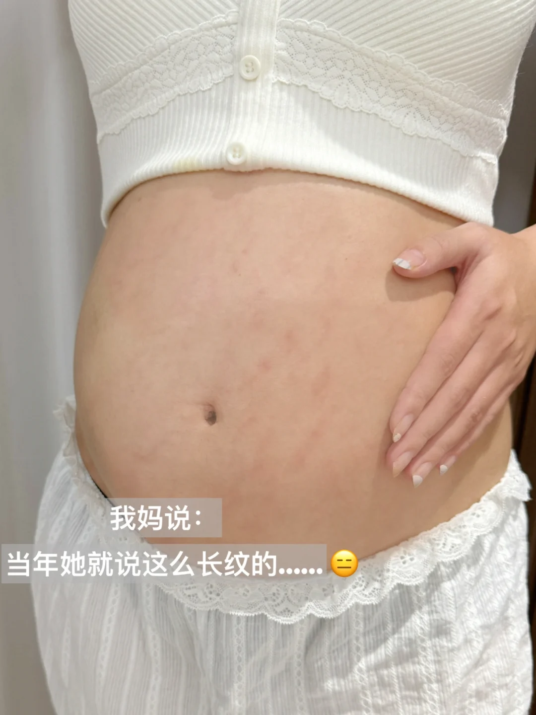 24周……妊娠纹遗传体质自救心得