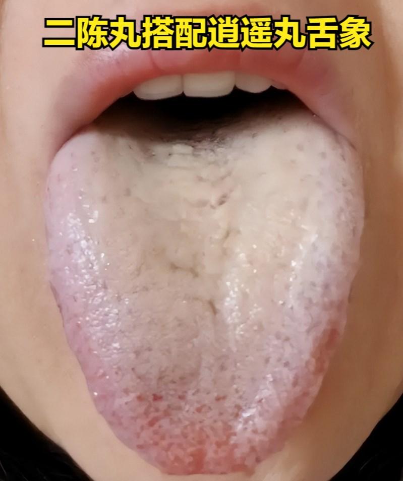 痰多生怪病，二陈丸用好了，体内90%的痰湿都挖干净
二陈丸+逍遥丸
适用：气滞痰