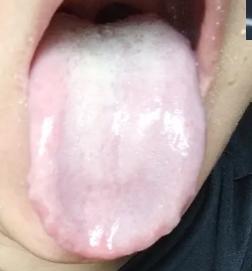 男人功能差，5种舌象5种方法，对照看自己是哪一种！

一、阳虚型：怕冷 + 舌淡