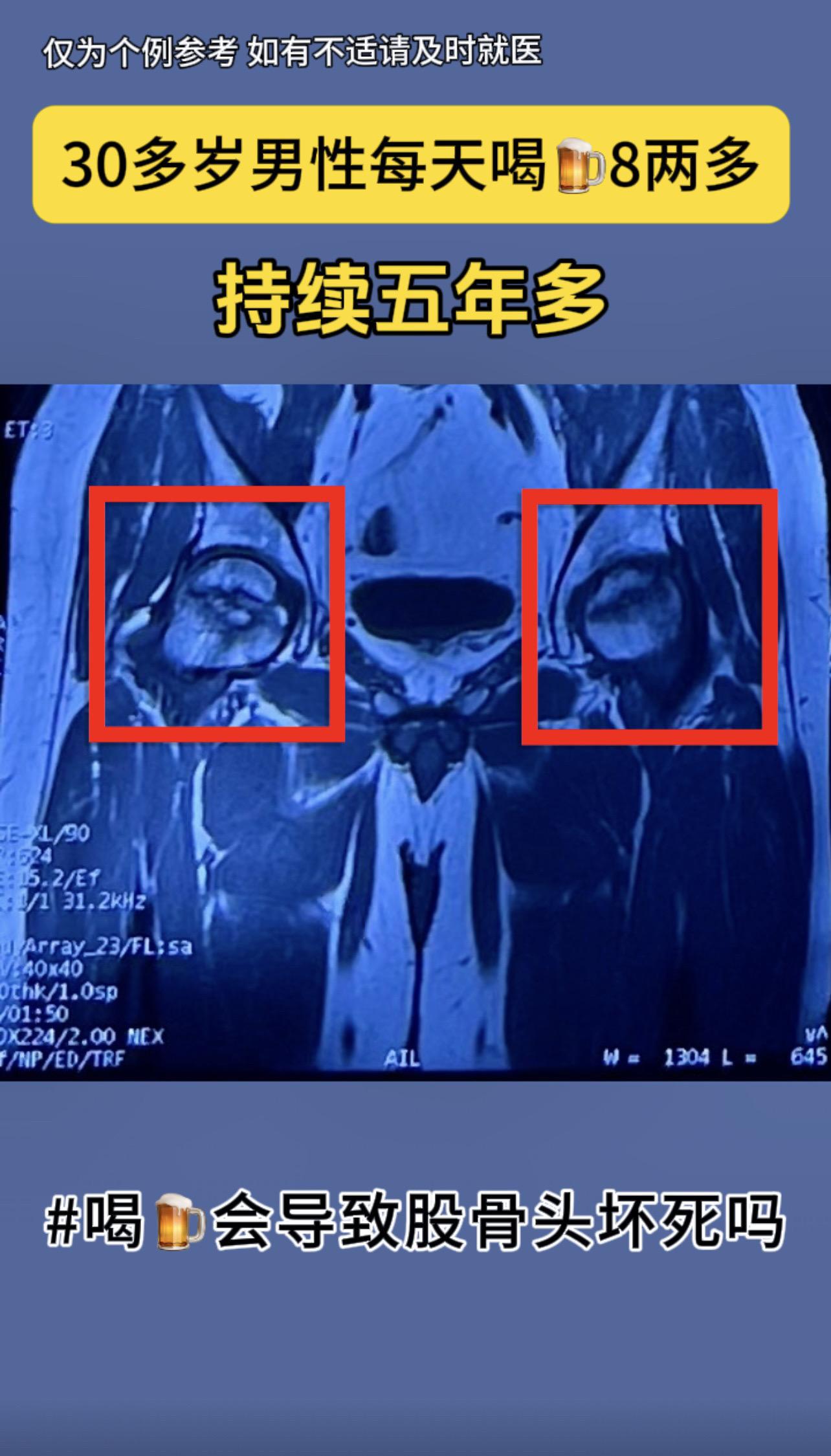 喝🍺会导致股骨头坏死吗？答案是：会的。30多岁男性，几乎每天喝🍺8两左右，连续五年多。
刚哥提醒：酗酒有风险，喝酒须节制。