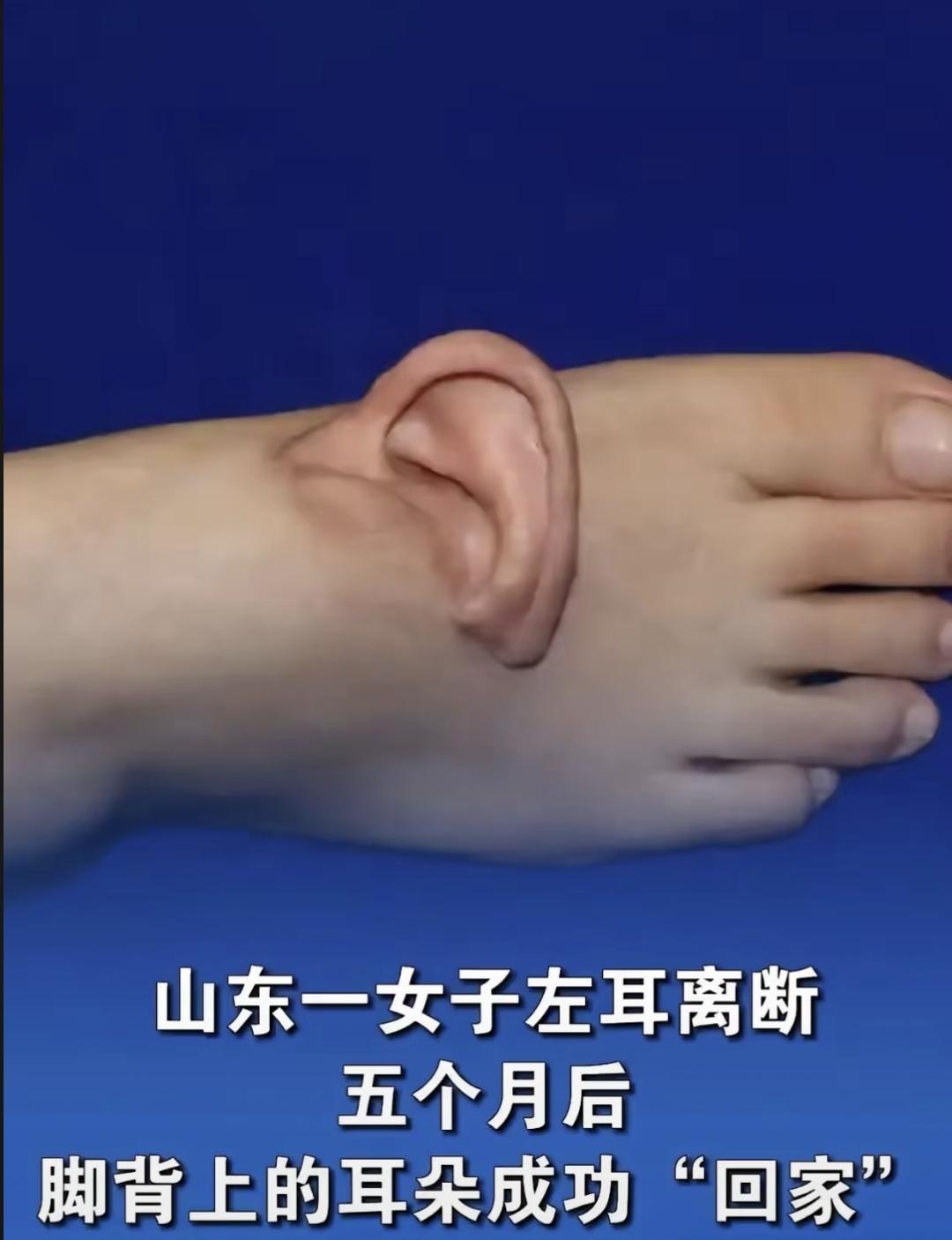 山东有个孙女士在厂里干活时，左耳被坏机器扯下来了。送到医院时快两小时了，医生说直