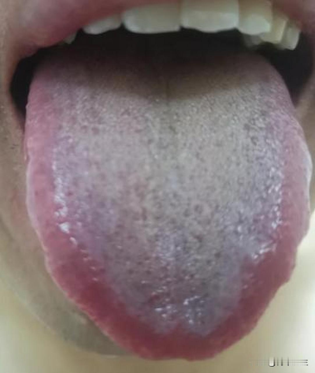 满口的白腻苔，以为是脾胃虚寒？那就大错特错了！

这是上个月来看诊的一位粉丝朋友