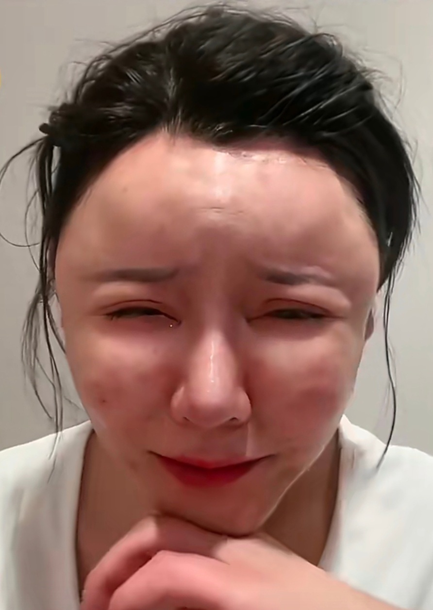 女子过度医美面部馒化酷似面具人 好可怕，大晚上看到这个，真的好吓人，也好唏嘘。非
