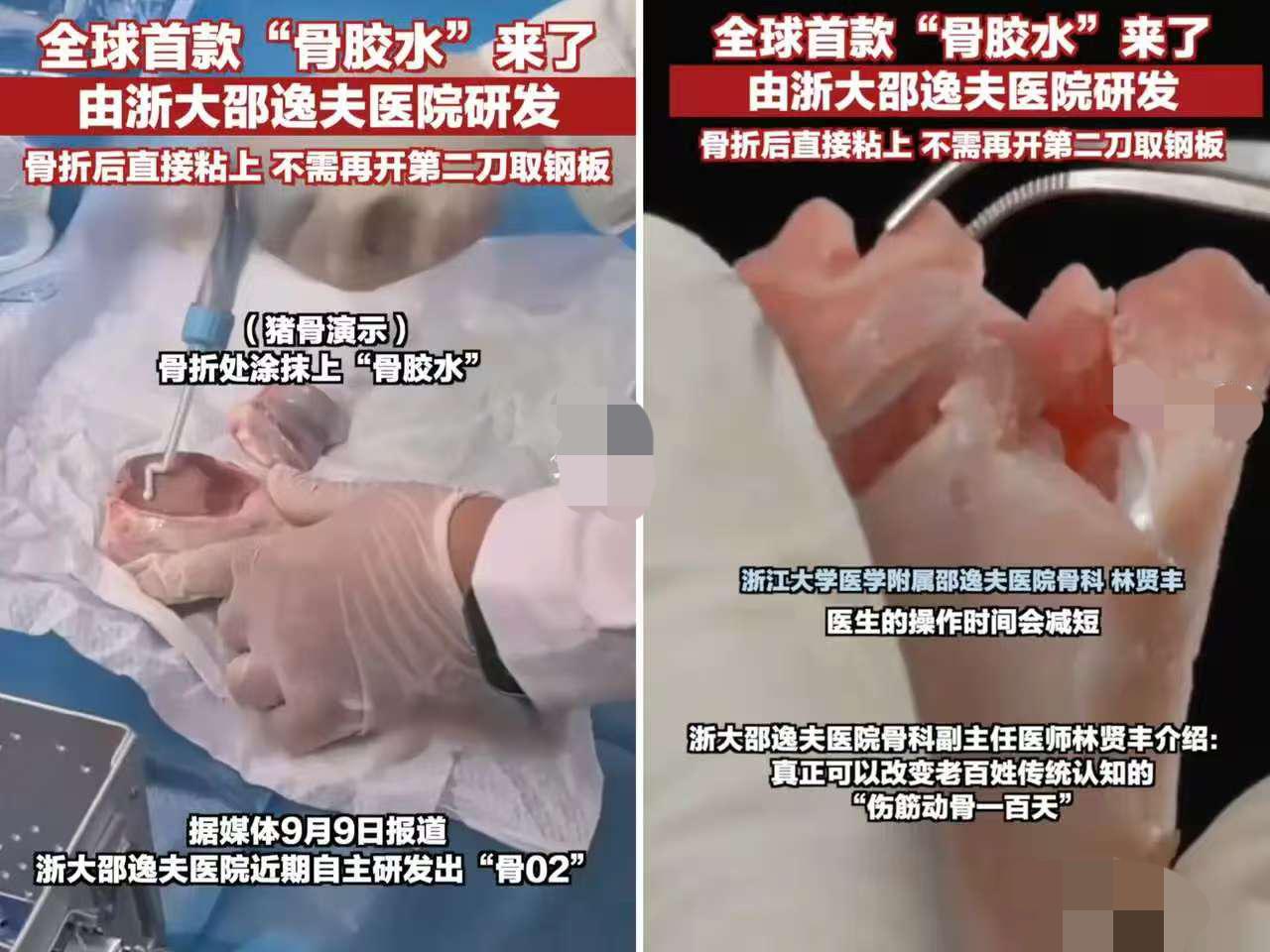 我有种强烈的预感，
邵逸夫医院研制的骨胶水，
未来可以用于牙齿上。毕竟
随着年龄