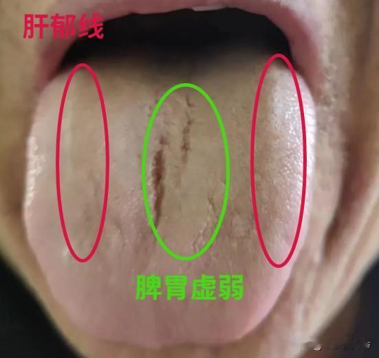 这种舌头，舌苔白腻、舌中有裂纹，但是吃多少归脾丸、参苓白术丸都不管用
病人主诉: