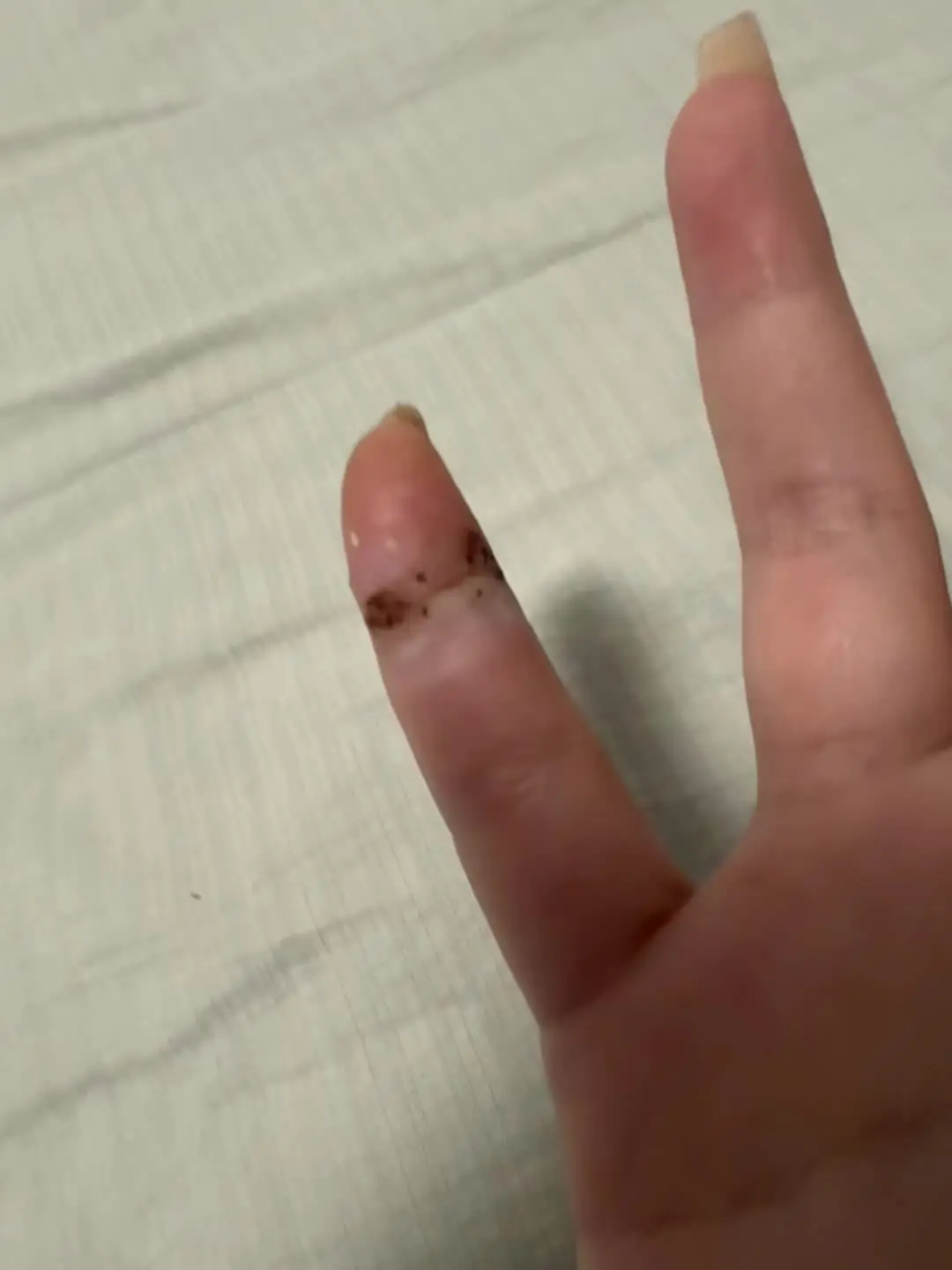 完了是不是严重了，我需要去医院吗，有没有懂医的替我看一下。因为每天做饭...