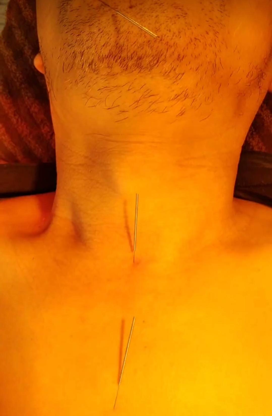 偷拍
这是一张于某三甲中医院，在临床扎针后偷拍所得的照片，照片中的患者为晚期肺癌