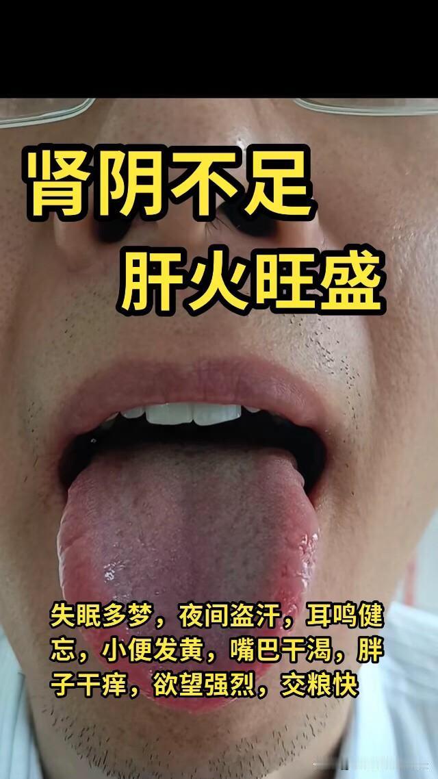 跟着侯医生给学舌诊，分享100位病友舌诊实战分析之——第一期#健康养生##脾胃虚