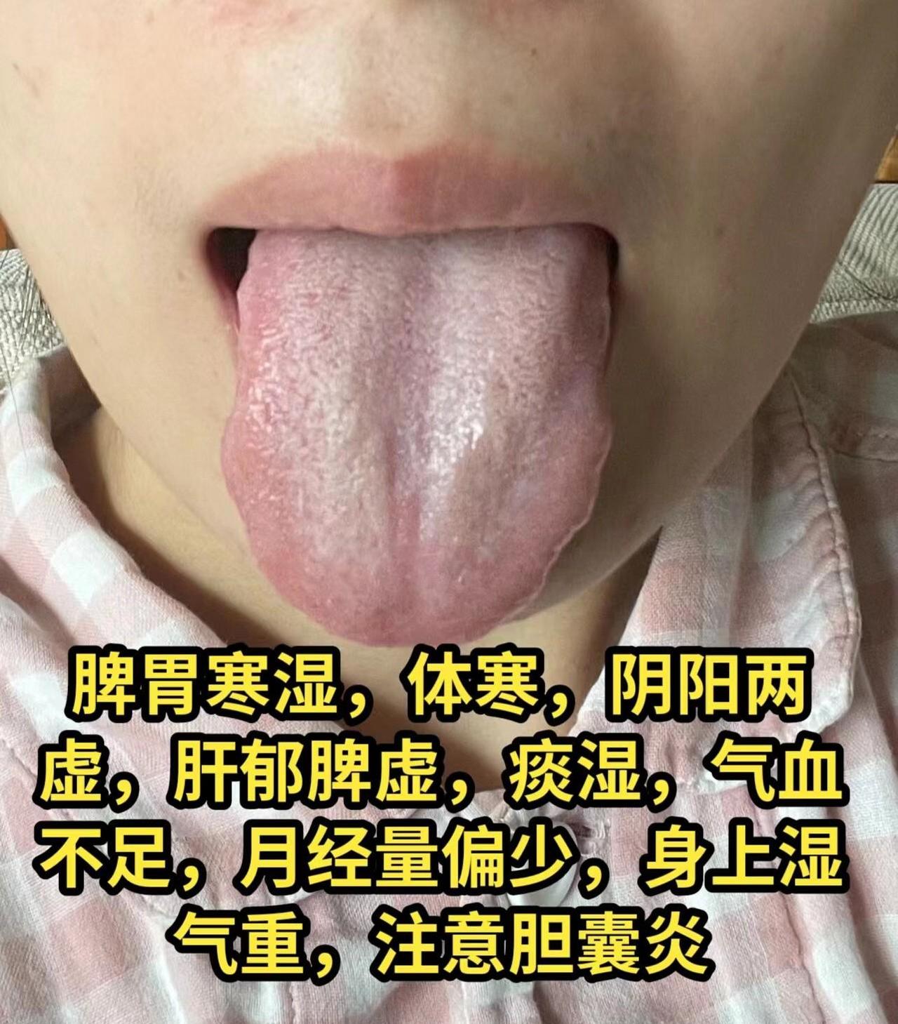 今天几个常见舌象舌诊例子：
1.脾胃湿寒， 体寒 阴阳两虚 月经量少 湿气重 气