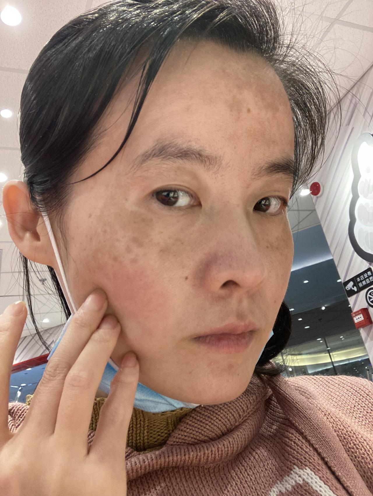 越来越严重，快成花脸了，怕耽误越久治疗效果越差，可是不搬家我都用不起来药，难过。