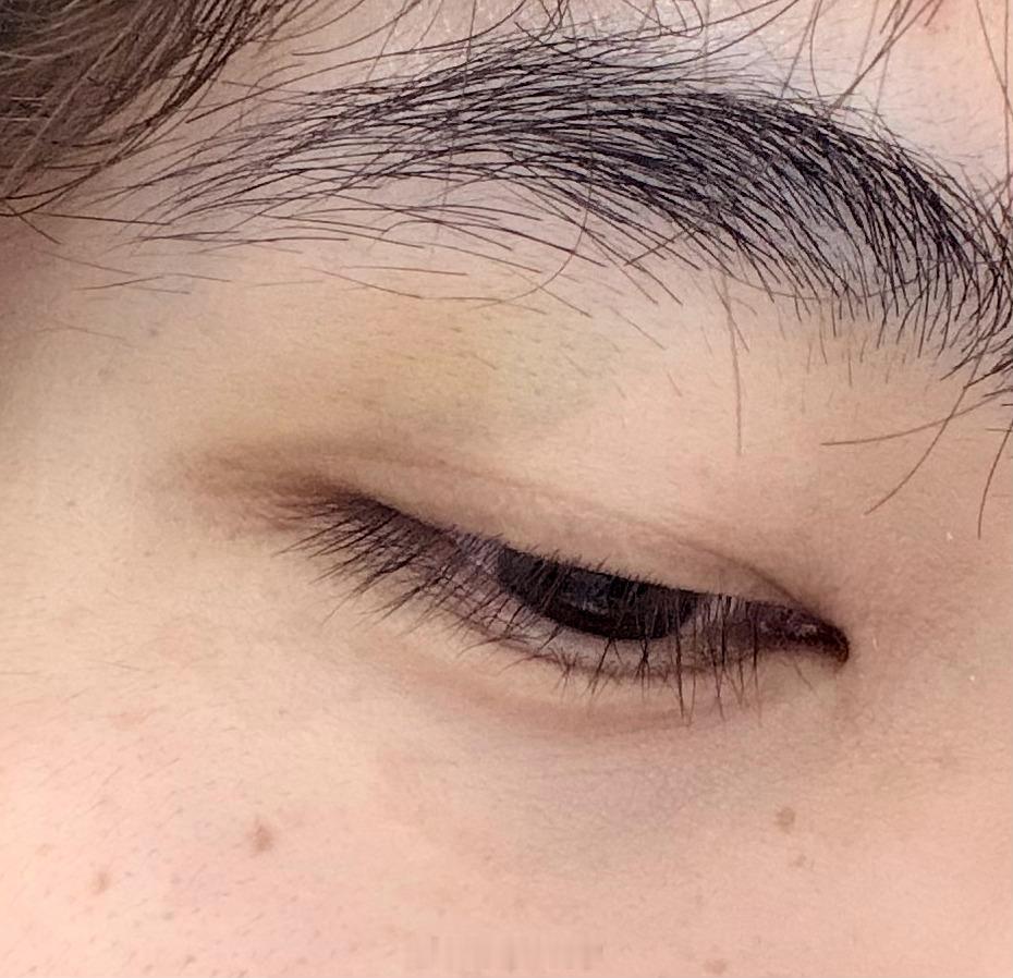 我真服了自己，盘着腿坐在椅子上，然后椅子翻了，然后眼镜打到我眼睛了，结果眼睛青了