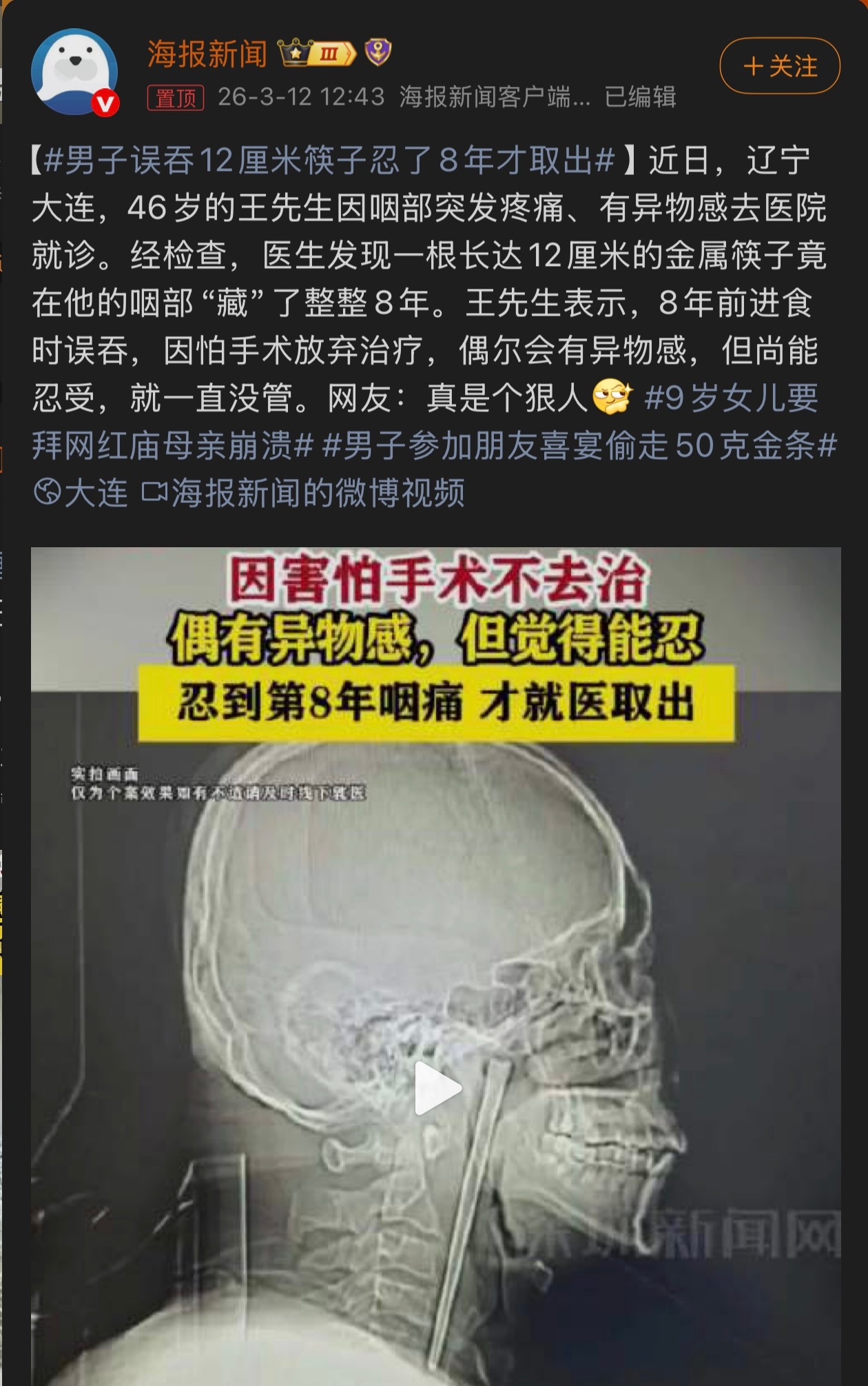 男子误吞12厘米筷子忍了8年才取出等会儿？你说多久？12厘米筷子在喉咙里卡了8年