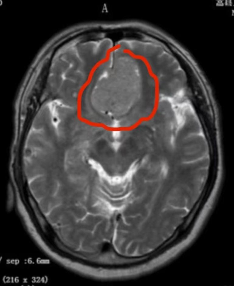 这个是脑膜瘤吗？58岁男性，洛阳市人。今年10月份单位作体检，发现这个...