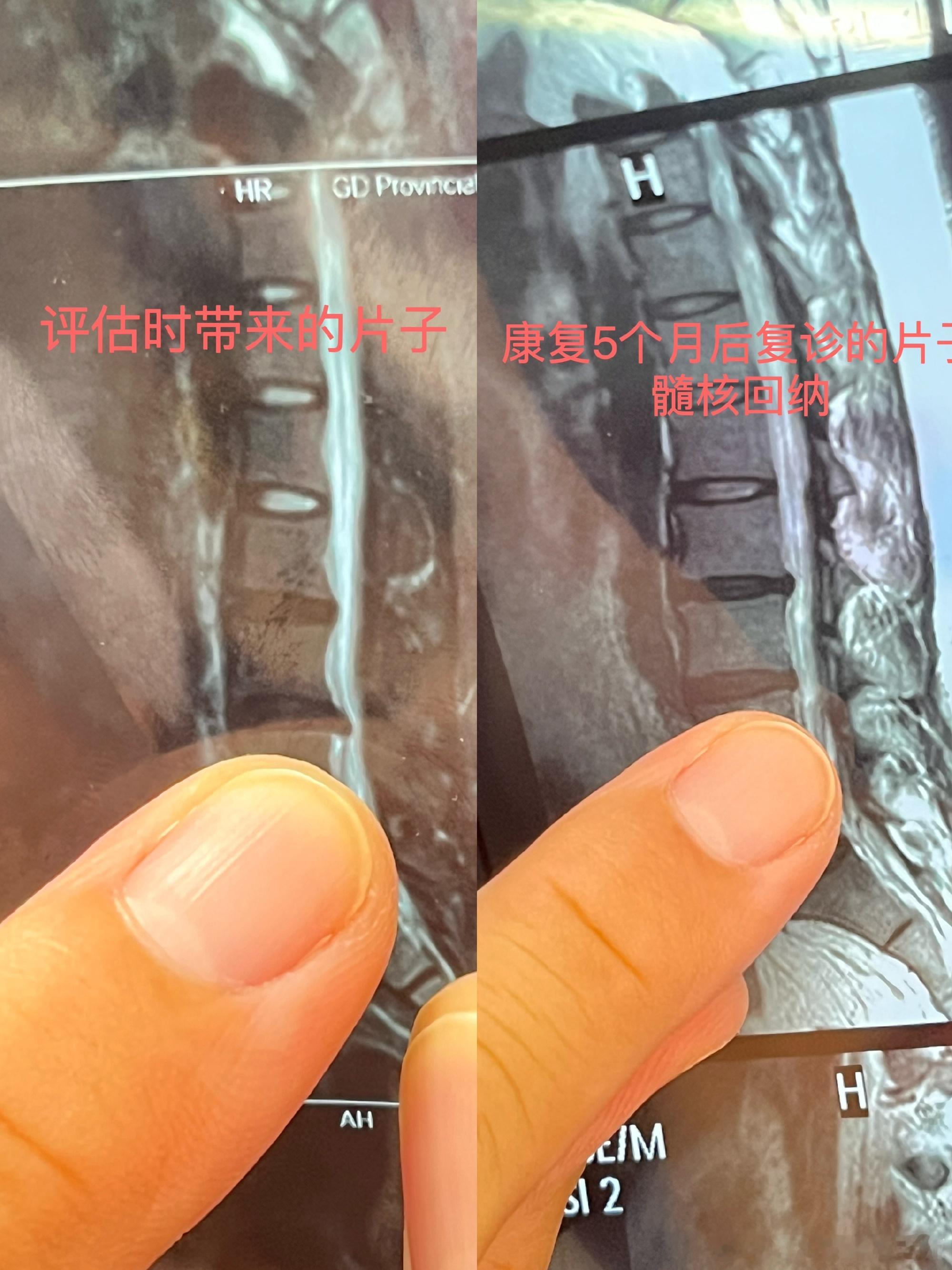 腰椎间盘突出﻿﻿ 之前一直讲，腰突是有概率回去的，我们线下就有腰突髓核回纳的患者