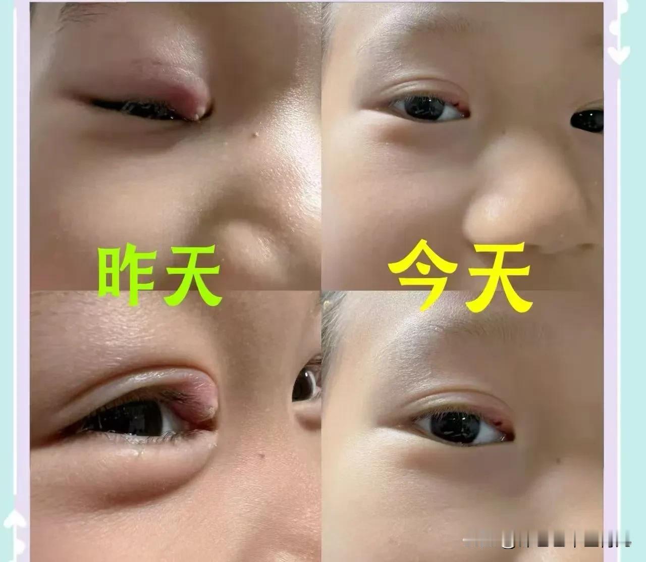 孩子麦粒肿调理对比，消肿效果看得见

实拍对比

昨天：内眼睑红肿鼓包，发炎明显