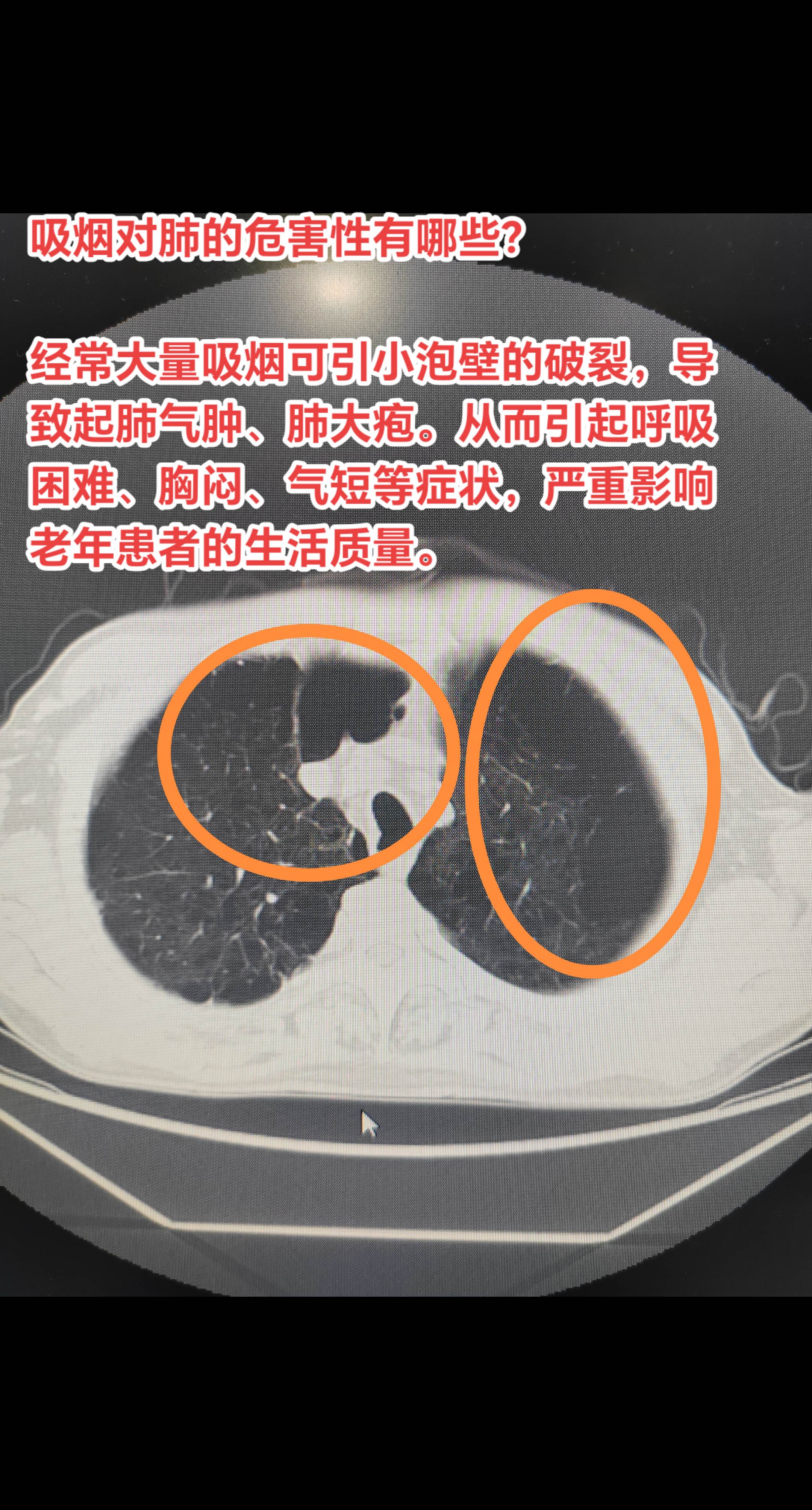 吸烟对肺的危害性有哪些？经常大量吸烟可引小泡壁的破裂，导致起肺气肿、肺...