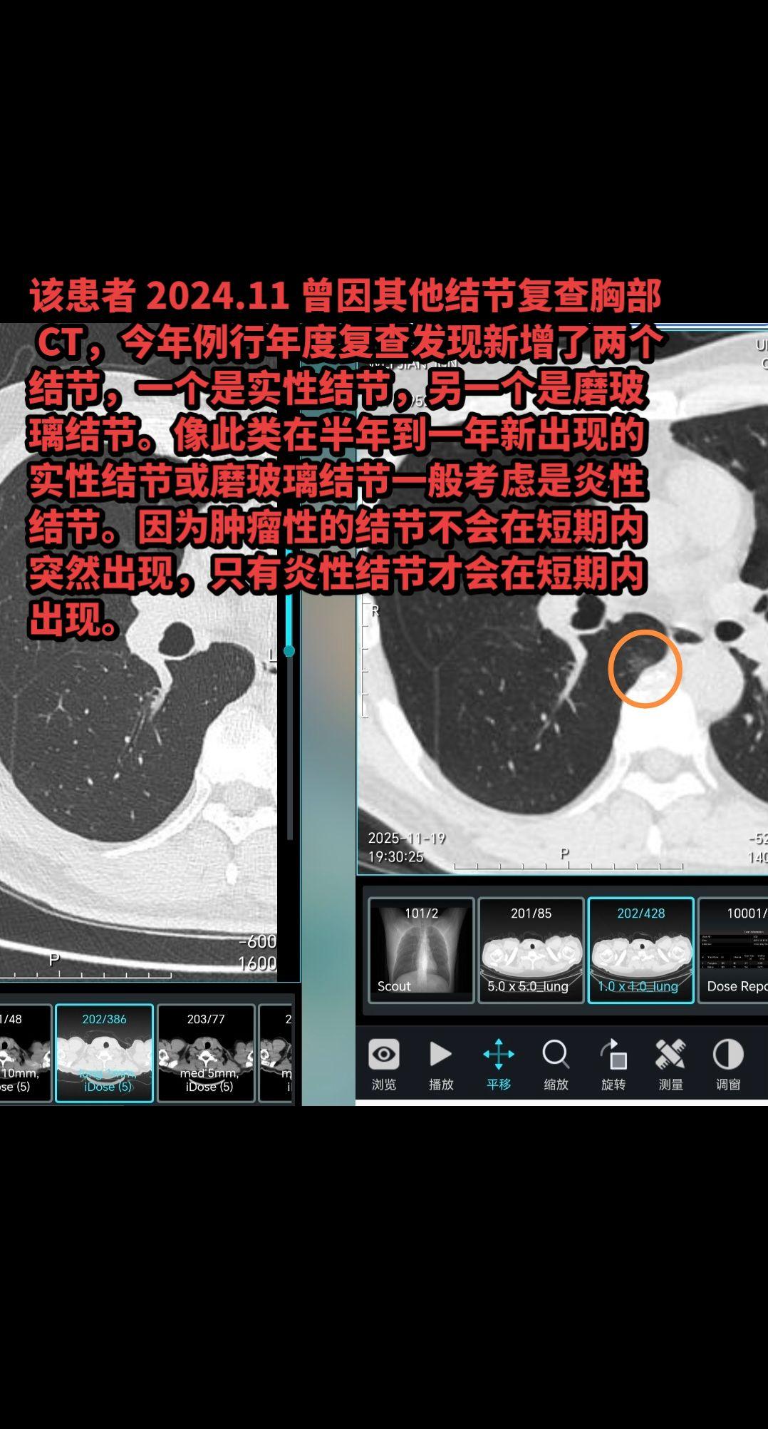 这类结节多考虑炎症，无须担心！该患者 2024.11 曾因其他结节复查...
