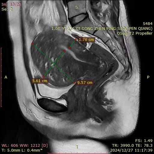 Microwave ablaiton for adenomyosis