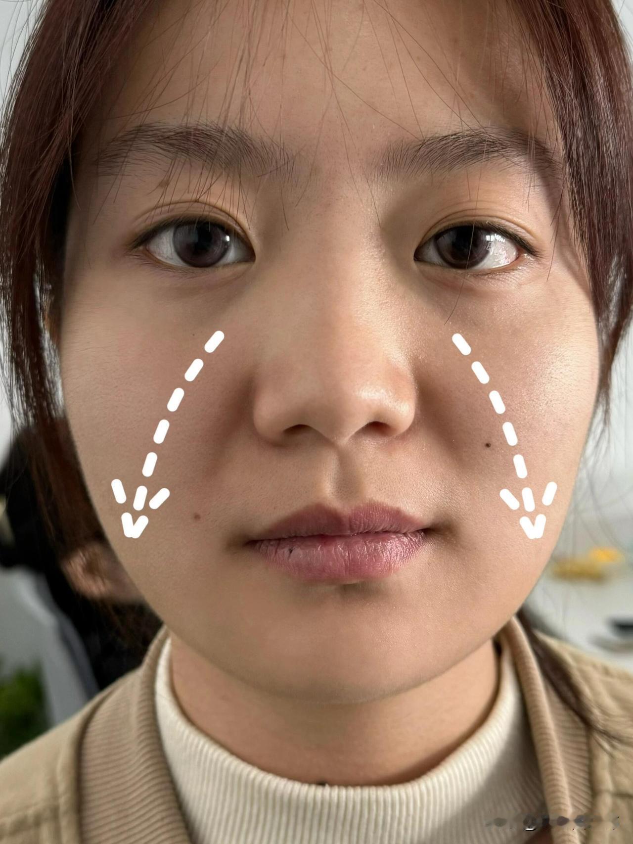 才23岁脸突然垮了。
不知道是不是经常熬夜的原因，鼻翼两边的凹陷越来越深，脸垮的