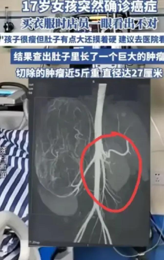广州，17岁女孩林晓雨陪妈妈逛街买衣服，在一家服装店试裤子时被老板娘看出肚子鼓得