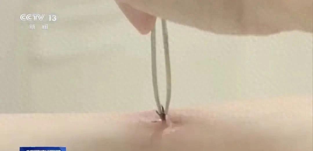 蜱虫藏身皮肤不痛不痒，感冒药吃了一周没用，它到底在身体里干了啥。

安徽一个大叔