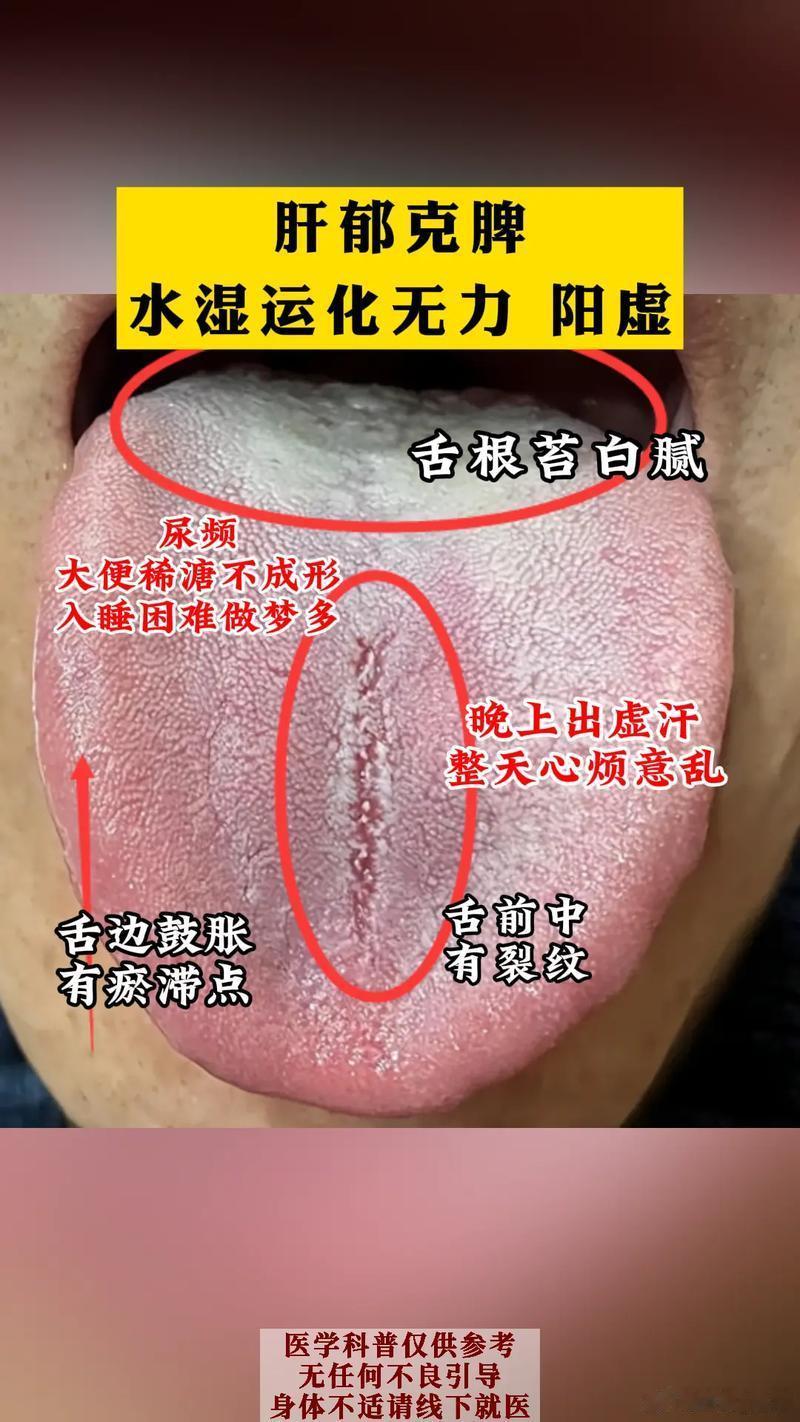 比三仁汤 除湿热 还强的1碗汤，上开水闸 下通水道，将湿热连根拔起说到湿热啊，它