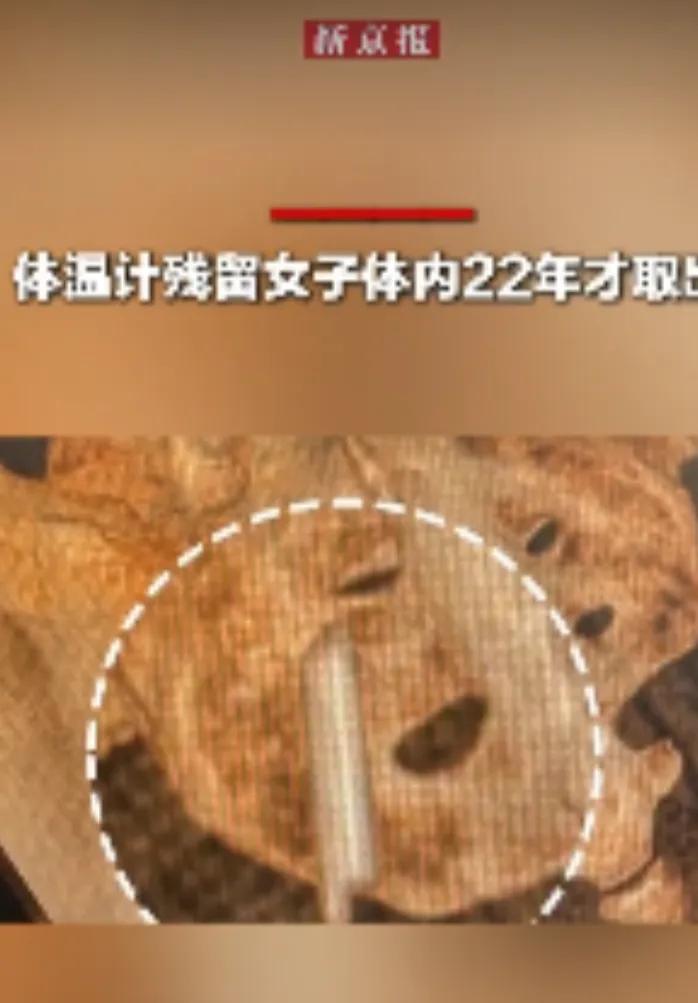 不可思议！湖北武汉，女子参加体检时，发现盆骨里有奇怪异物，足足有2公分长！手术取
