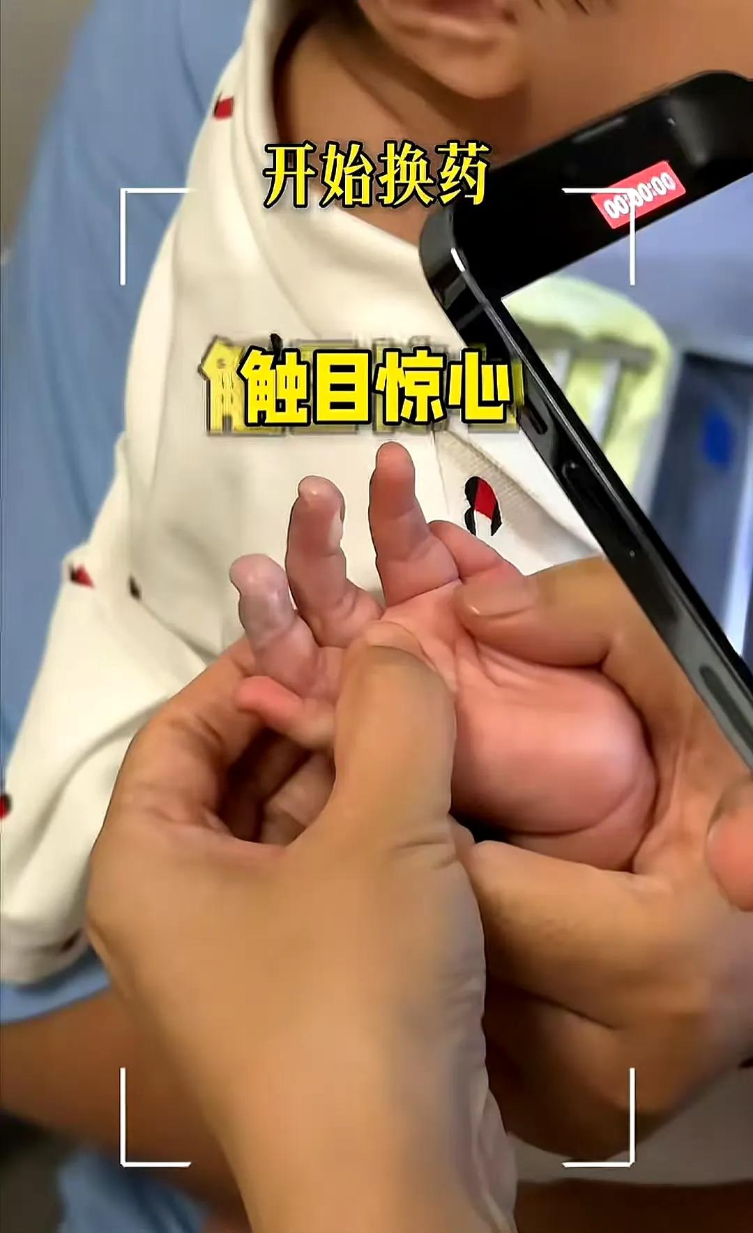 太气愤！9个月宝宝被保姆烫伤！
事后还隐瞒！
这绝对不能忍！
74岁张纪中9个月
