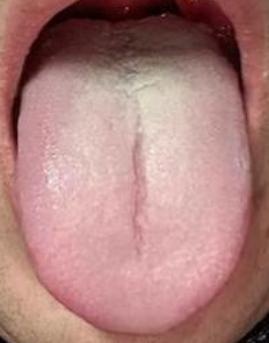 【舌诊分析】湿热不除，再怎么健脾补肾也不过是杯水车薪！

这位粉丝的情况是这样的