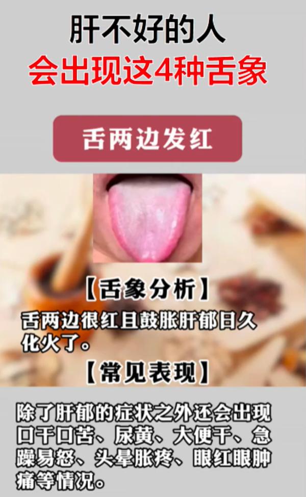 肝不好，舌头先知道！4 种典型舌象，在家自查