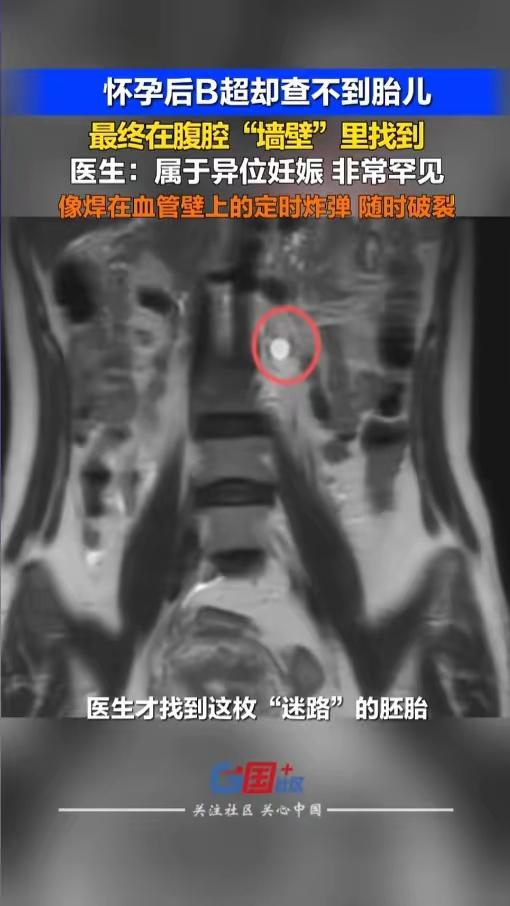 5月7日，深圳一名女子验孕棒显怀孕，医院检查却爆出惊魂一幕。
 
抽血确认妊娠无