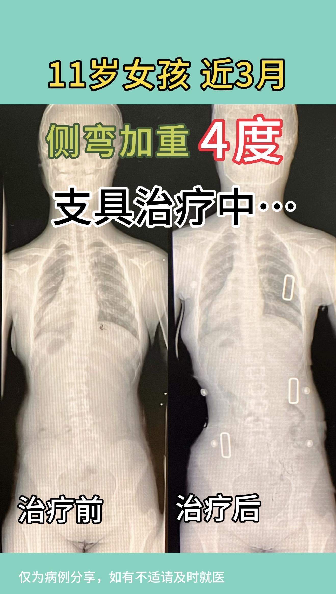 11岁女孩，近3月侧弯加重4度，支具治疗中，支具即时矫正效果好。定期复查中。
