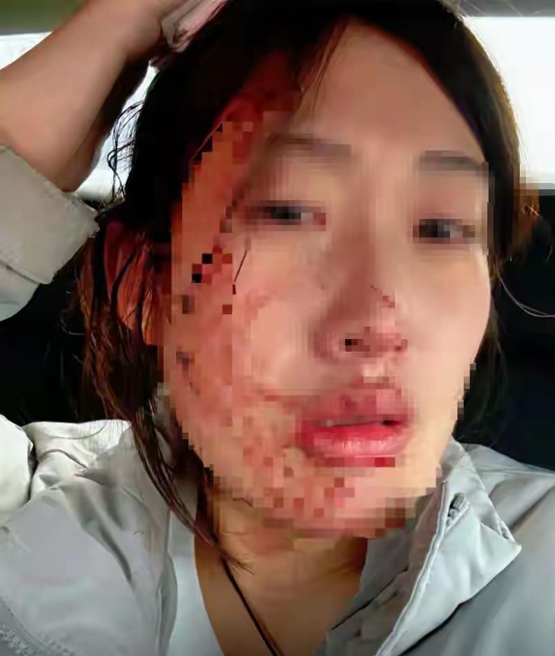 护士遭患者家属殴打，两拳打成脑震荡，警方介入，结局大快人心。

真实情况是，第一