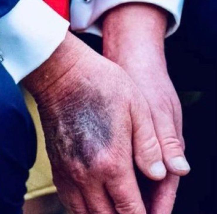 国外网友说，是中风了，正在接受治疗。

又说，好像不太严重，但是一天之内是不可能