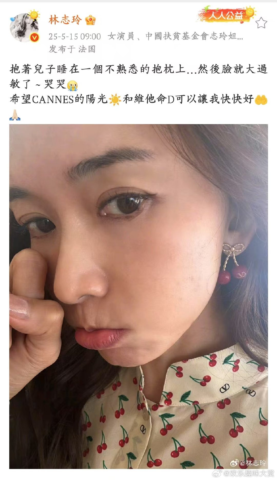 林志玲的脸大过敏 好心疼，谁能想到睡个觉还能让志玲姐姐遭遇过敏困扰，愿阳光和维 