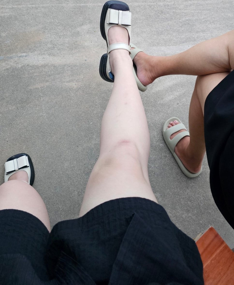 我每次去皮肤科都要做一堆皮肤项目，最近不变的几个搭配就是LAHLA焕肤+皮秒+翠