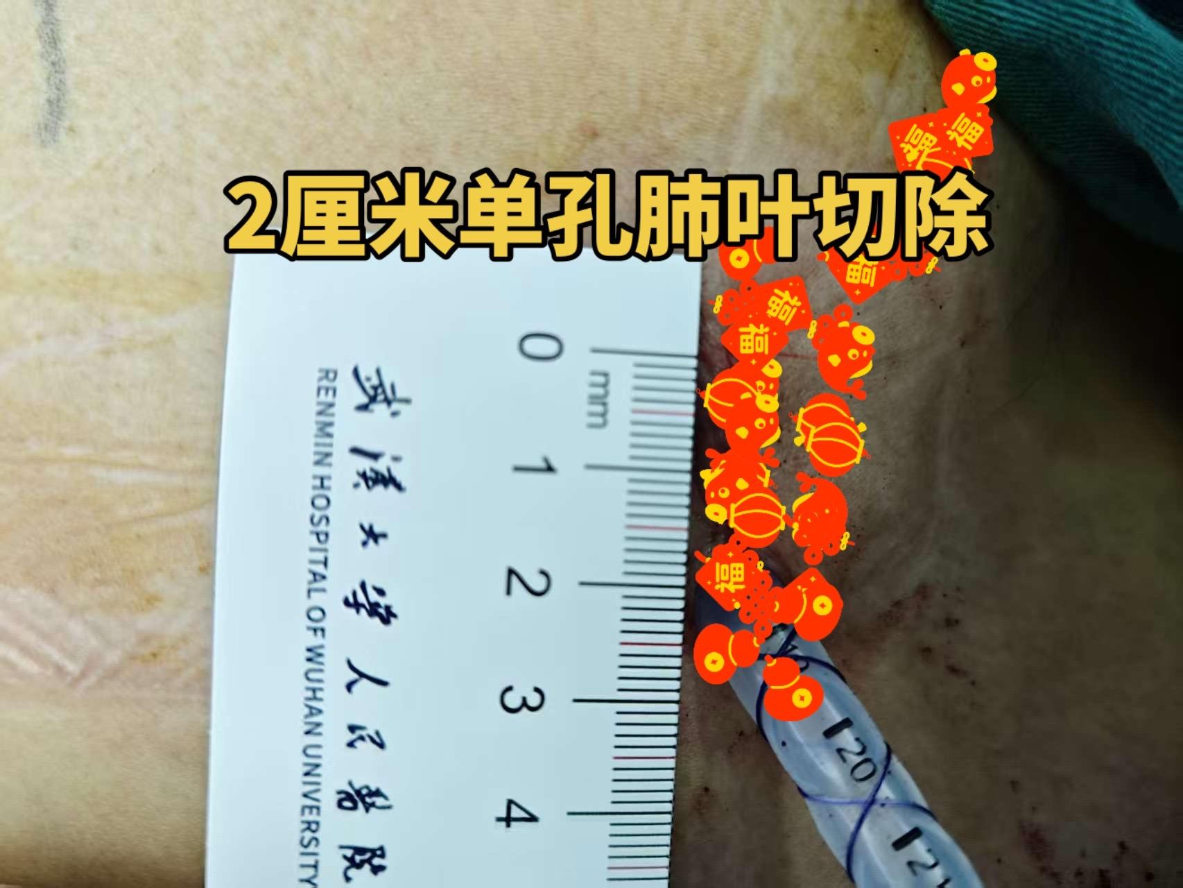 超级单孔肺叶切除。现在我很少做肺叶切除，但是该切的时候还得切。一个肺里...