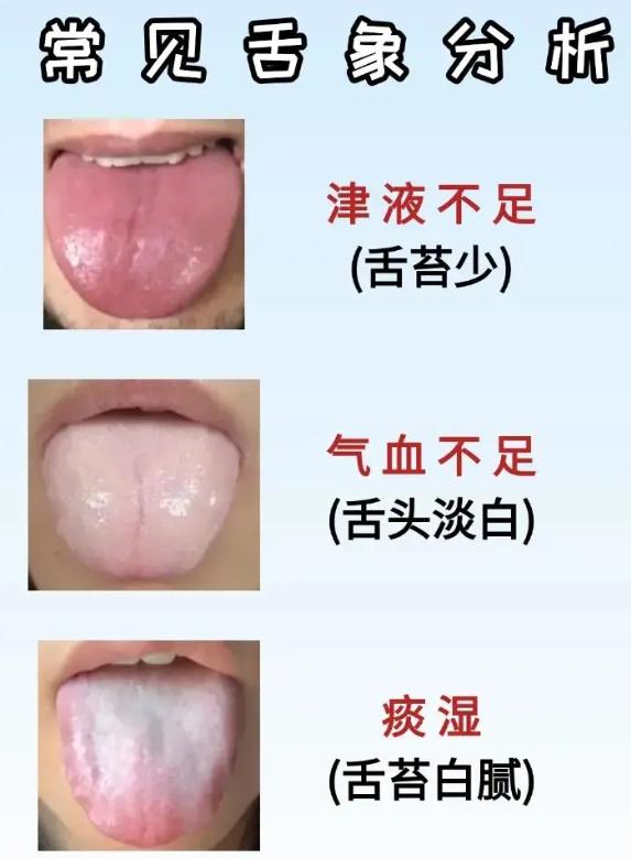 6 种常见舌象，看懂身体信号