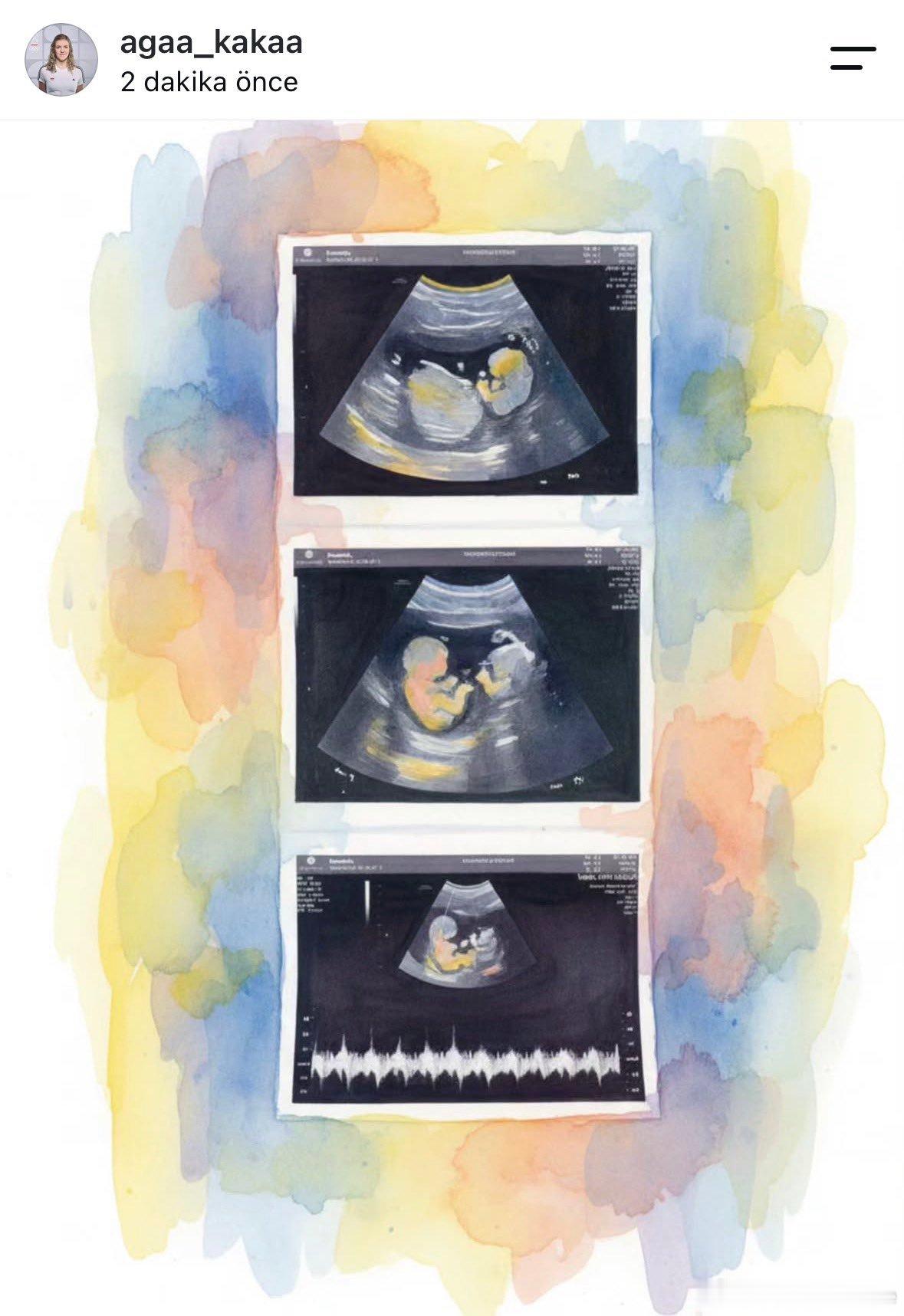 排球 👶已经结束排球生涯的波兰名将阿格涅什卡·科尔内卢克，宣布自己即将为人母。