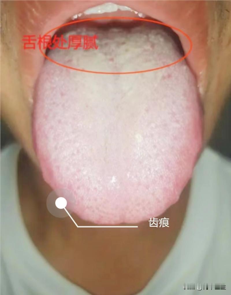 舌头有齿痕，可不能一味的健脾祛湿，还有其他的原因

今天看了一个患者，他说自己舌