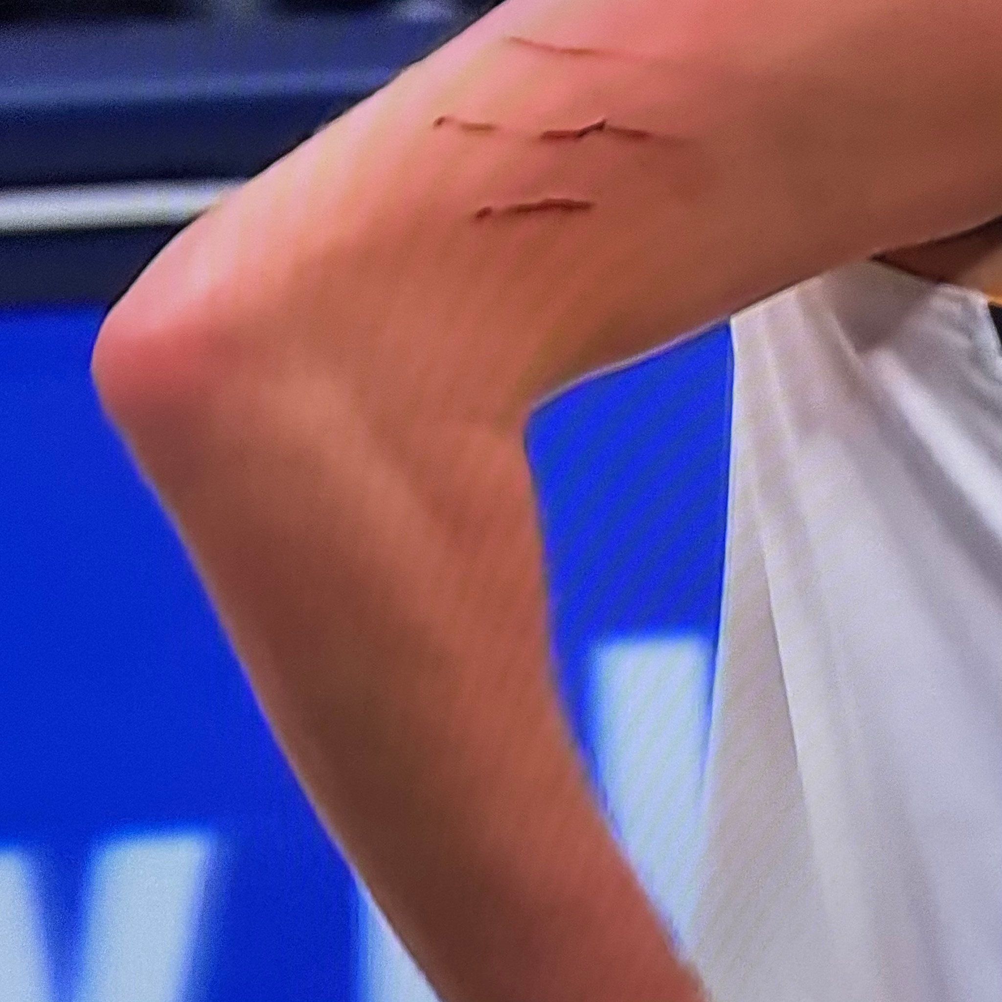 约基奇的伤痕。 