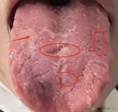 红舌不补阳，白舌不滋阴，记好这两步，补肾不走弯路

①.红舌不补阳——舌质发红发