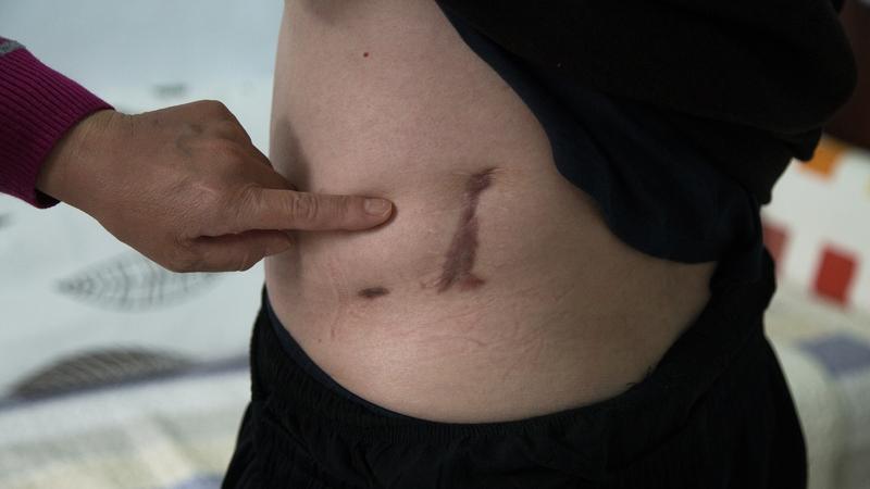 29岁女生确诊尿毒症晚期，再也无法小便，提醒：一定要远离饮料、外卖，改掉熬夜、憋